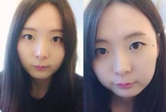 做一次双眼皮手术要多少钱 做一次双眼皮手术要多少钱