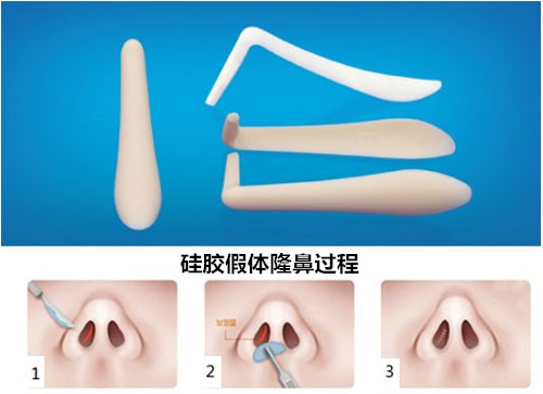 鼻部综合整形的误区有哪些