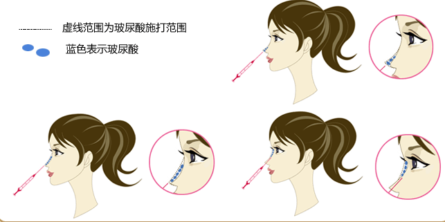 鼻部综合整形的误区有哪些