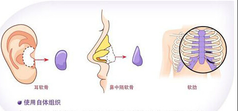 鼻部综合整形的误区有哪些