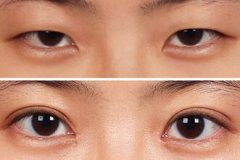 怎么看割双眼皮手术后的果 怎么看割双眼皮手术后的果