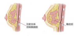 吸脂隆胸痛吗 吸脂隆胸痛吗