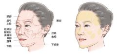 自体脂肪丰面颊能维持多久了 自体脂肪丰面颊能维持多久了