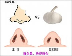 蒜头鼻怎么变小了 蒜头鼻怎么变小了