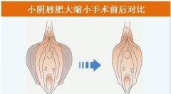 阴蒂整形有什么后遗症