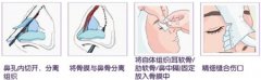 疤痕体质能隆鼻吗 疤痕体质能隆鼻吗