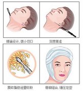 面部吸脂和B****哪个果好