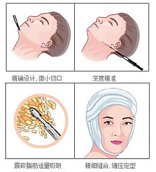 面部吸脂和B****哪个果好