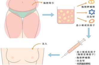 水滴型假体和圆型假体有什么区别?哪个好