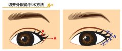 韩式开眼角手术多少钱呢