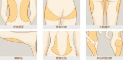 激光溶脂手术有什么副作用 激光溶脂手术有什么副作用