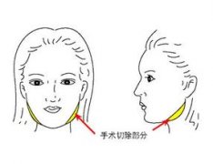 去咬肌手术有什么优缺点 去咬肌手术有什么优缺点