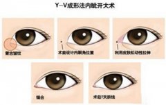 开眼角手术的果怎么样 会让眼睛发炎吗 开眼角手术的果怎么样 会让眼睛发炎吗