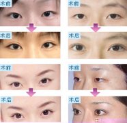韩国专家为您送上眼部整形6问答 韩国专家为您送上眼部整形6问答