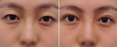 韩国专家讲解埋线双眼皮手术注意事项 韩国专家讲解埋线双眼皮手术注意事项