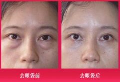 祛眼袋手术的并发症有哪些?如何处理 祛眼袋手术的并发症有哪些?如何处理