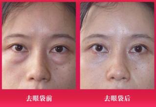 祛眼袋手术的并发症有哪些?如何处理