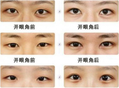 开内眼角手术前后注意事项 开内眼角手术前后注意事项