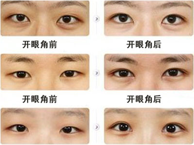 开内眼角手术前后注意事项