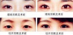 双眼皮手术适应人群