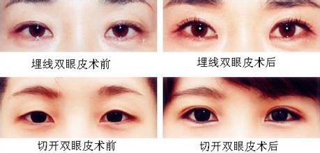 双眼皮手术适应人群