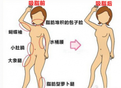 上海吸脂手术多少钱