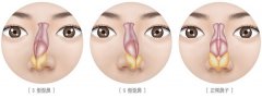 鼻软骨歪了怎么矫正 鼻软骨歪了怎么矫正