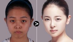 做光子嫩肤对皮肤伤害大吗