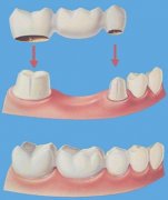 烤瓷牙有副作用吗
