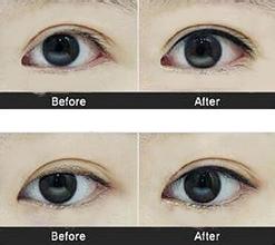 影响双眼皮果的因素