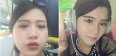 双眼皮手术有哪几种方法
