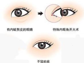 双眼皮手术有哪几种方法