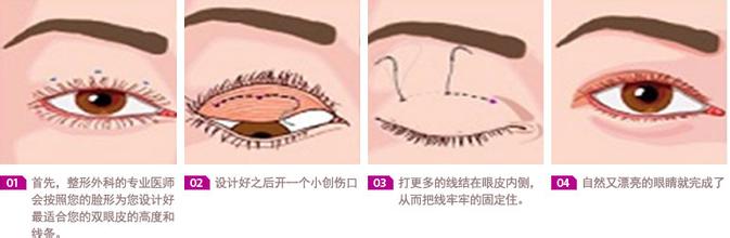 双眼皮手术有哪几种方法