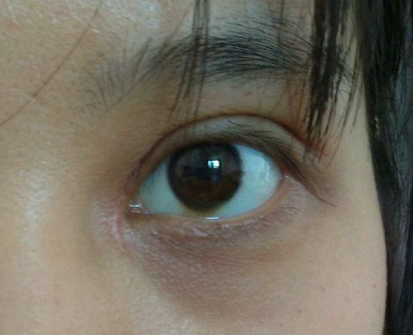 眼部疤痕整形手术注意事项