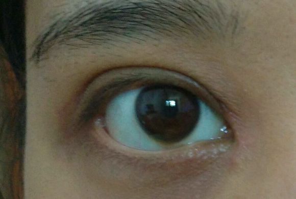 眼部疤痕整形手术注意事项