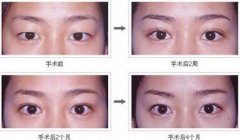 埋线双眼皮多久能恢复
