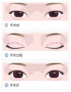 割双眼皮果能保持多久