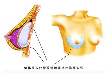 假体,隆胸,致癌