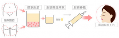 自体脂肪丰下巴的手术过程是怎样的 多久能恢复