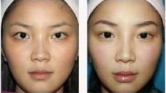 眼部疤痕整形手术注意事项