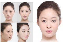 手术去眼袋多久恢复 手术去眼袋多久恢复