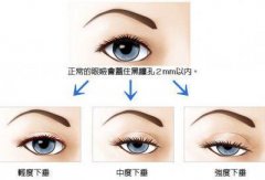 眼睑为什么会下垂了 眼睑为什么会下垂了