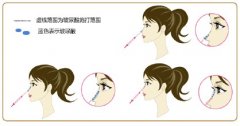 注射隆鼻副作用和好处分别是什么 注射隆鼻副作用和好处分别是什么