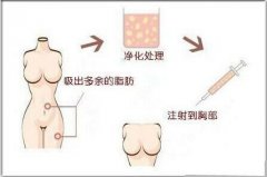 自体脂肪丰胸的费用是多少呢 自体脂肪丰胸的费用是多少呢