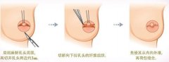 乳头内陷矫正手术的副作用是什么 乳头内陷矫正手术的副作用是什么