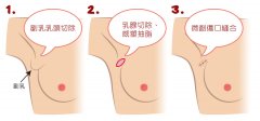 副乳切除后会不会复发 副乳切除后会不会复发