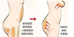 自体脂肪填充丰臀能维持多久 自体脂肪填充丰臀能维持多久