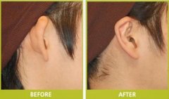 招风耳矫正后多久可以恢复 招风耳矫正后多久可以恢复