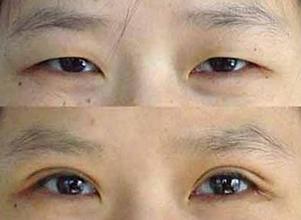 双眼皮手术价位