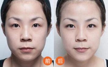 隆眉弓手术适应症